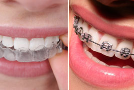 braces