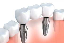 dental-implants